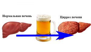 Синдром «Баварского» сердца и потребление пива: прямая связь