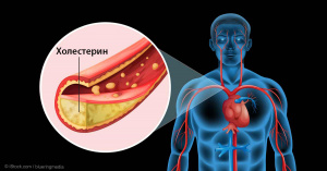   ПОВЫШЕННЫЙ ХОЛЕСТЕРИН - ПРЯМАЯ УГРОЗА ИНФАРКТА, ИНСУЛЬТА И ДАЖЕ ЛЕТАЛЬНОГО ИСХОДА